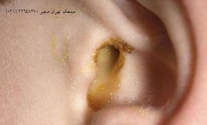 ترشح گوش 