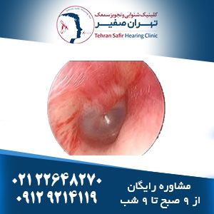 معرفی بیماری گوش میانی