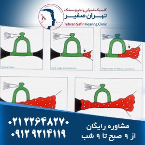 اتواسکلروزیس گوش میانی