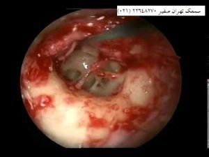 اتواسکلروزیس