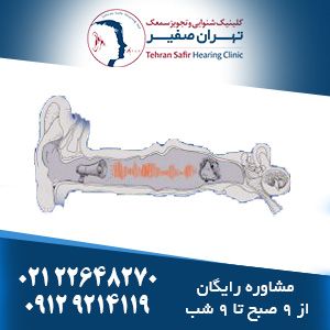 انواع وزوز گوش و درمان قطعی وزوز گوش