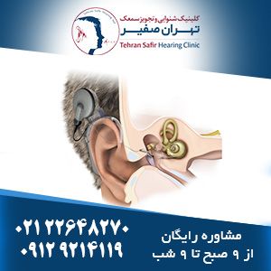 معرفی کاشت حلزونی