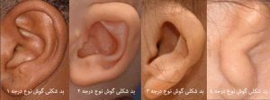 جراحی میکروتیا چطور است