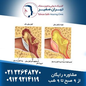 عفونت گوش میانی