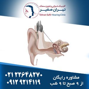 ایمپلنت گوش چیست و تفاوت کارینا با دستگاه های نیمه ایمپلنت
